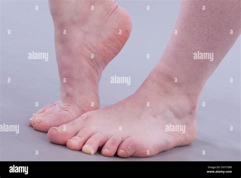 Gross Foot Stock Photos and Pictures